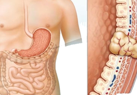 Khối u mô đệm đường tiêu hóa(GIST) có cần phẫu thuật hay không?